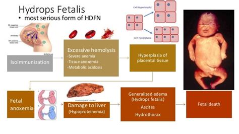 Manifestation Of Hdfn And Prophylaxis Of Rh Isoimmunization