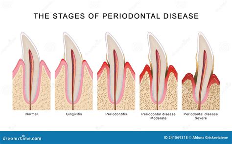 The Stages Of Periodontal Disease Stock Photo CartoonDealer