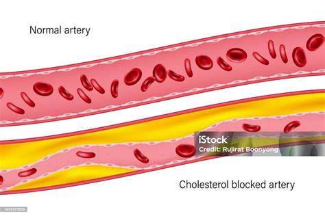 Normal Artery And Cholesterol Blocked Artery Clogged Arteries Caused By