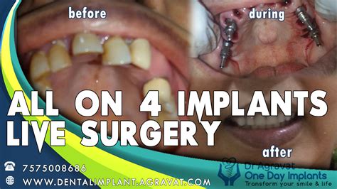 All on 4 Dental Implant Surgery Step by Step Procedure VideoFamous best Cosmetic Implants ...