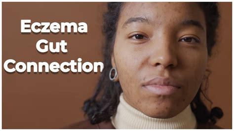 The Gut Eczema Connection YouTube