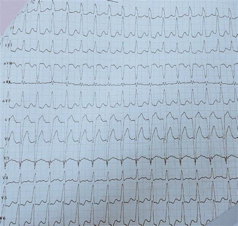 YE-MEDICAL on Twitter: "#yemedical 55 y/o male with dyspnea #ECG What ...