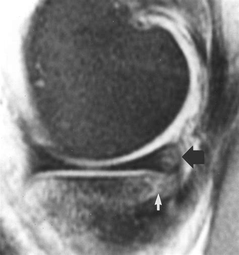 Mr Imaging Of Meniscal Contusion In The Knee Ajr