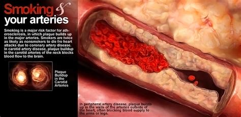 Smoking And Peripheral Artery Disease Storymd