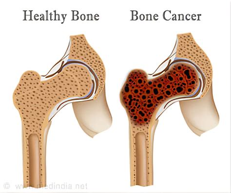 Bone Cancer(sarcoma) - Purwanchal Cancer Hospital