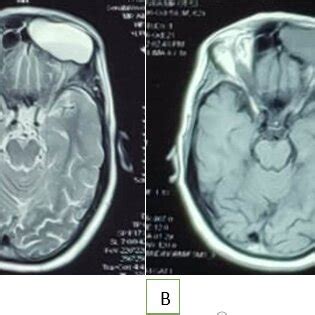 A Preoperative T2 Weighted Magnetic Resonance Imaging Of The Nose And