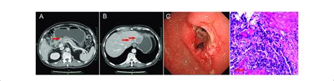 Abdominal Ct Scans And Gastroscopy Findings At Baseline A Download Scientific Diagram