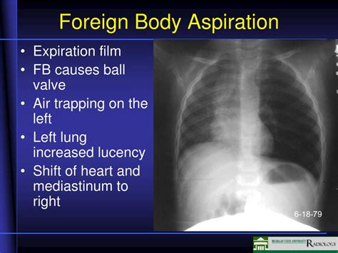 Ppt Airway Disease Powerpoint Presentation Free Download Id1836815