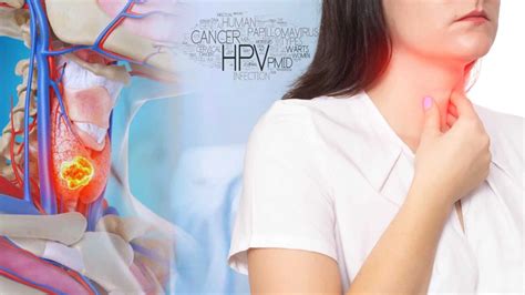 Virusul HPV In Gat Diagnostic Simptome Metode De Tratament