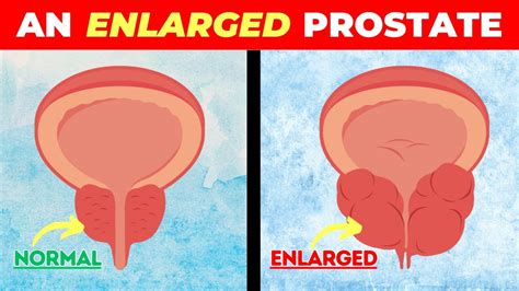 Enlarged Prostate Bph Signs And Symptoms Of Enlarged Prostate Youtube