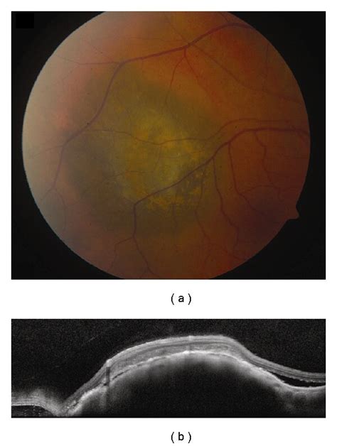 Choroidal Melanoma A Small Choroidal Melanoma With Overlying RPE