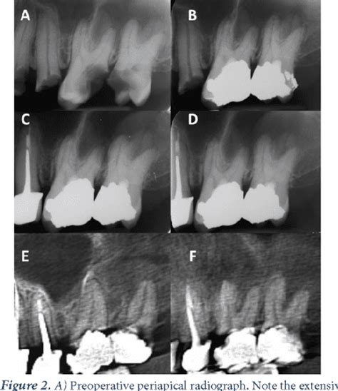 PDF Treatment Outcomes Of Full Pulpotomy As An Alternative To Tooth