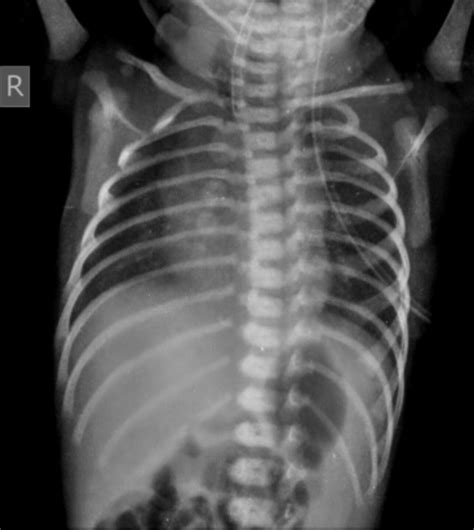 Esophageal Atresia X Ray