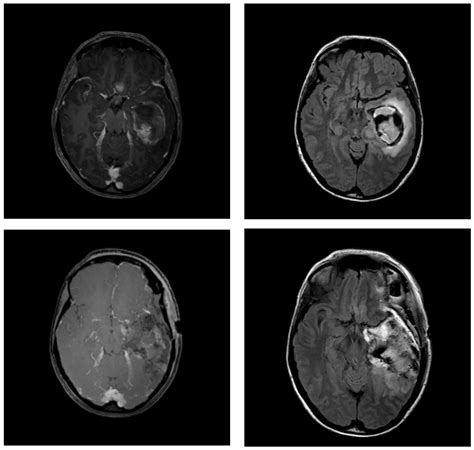 Impact Of Postoperative Changes In Brain Anatomy On Target Volume