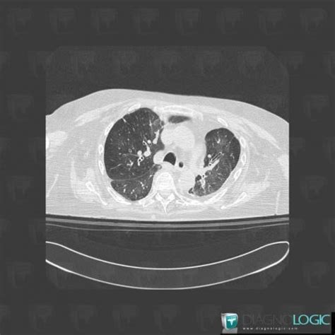 Radiology case : Pulmonary edema (X rays ,CT) - Diagnologic