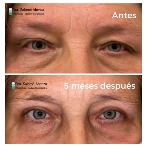 Antes y después Blefaroplastia superior Salomé Abenza