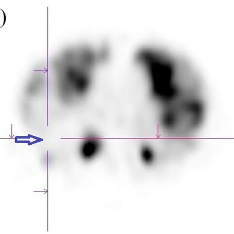 Patient No Perfusion A Ventilation B And Ct Scan C Blue