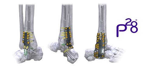 Paragon 28 Inc Increases Its Robust Hindfoot Fusion Plating Offering