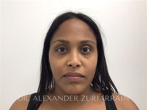 Neck Liposuction Before And After Case 02 Zuri Plastic Surgery