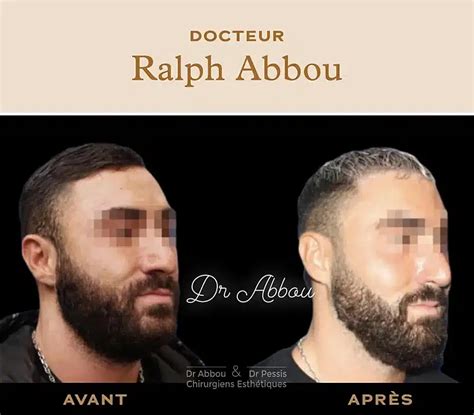 Avant Apr S Bichectomie Dr Abbou