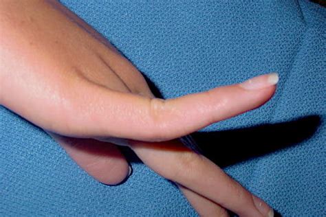 VOLAR PLATE RUPTURE Hand Surgery Source