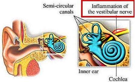 Vestibular Neuritis Symptoms Treatment What Is Causes