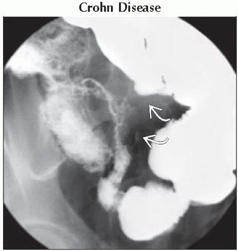 Da Db Stenosis Terminal Ileum Ffu Abdominal Key