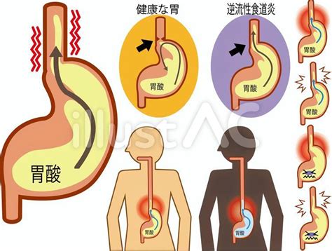 逆流性食道炎の胃①イラスト No 851457｜無料イラスト・フリー素材なら「イラストac」