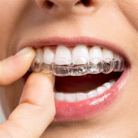 Invisible Braces Invisalign Therapy For Adults And Young People