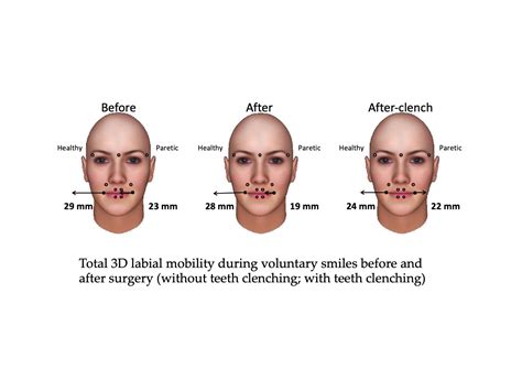 Smile Reanimation With Masseteric To Facial Nerve Transfer Plus Cross