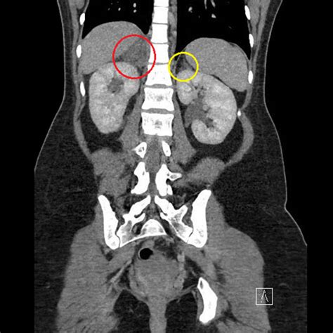 Non Hemorrhagic Unilateral Adrenal Infarct In Pregnancy Journal Of