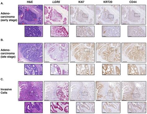 Expression Of Lgr In Invasion And Adenocarcinoma A Representative