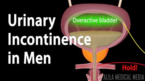 Urinary Incontinence in Men, Animation - YouTube