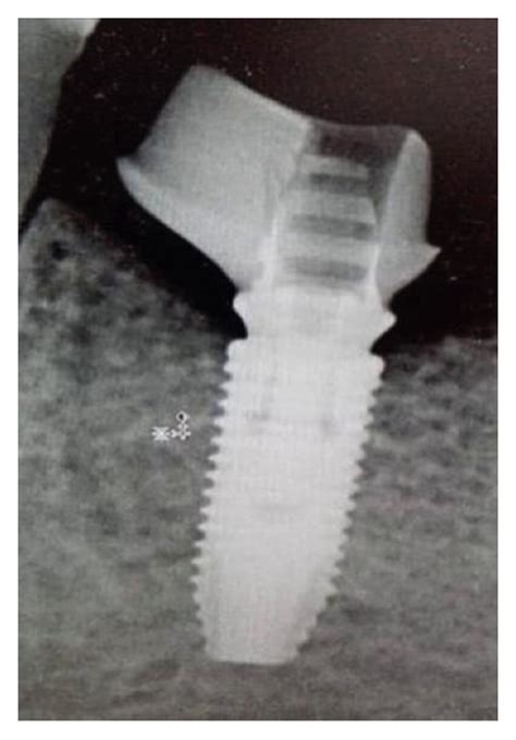 Stages Of Application Of A Customized Composite Abutment With Immediate