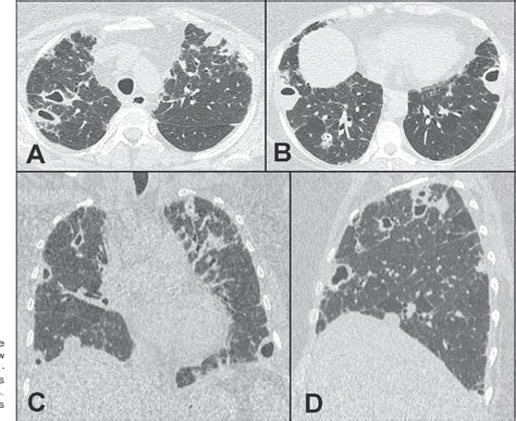 Figure From Pleuropulmonary Blastoma Manifesting As Spontaneous