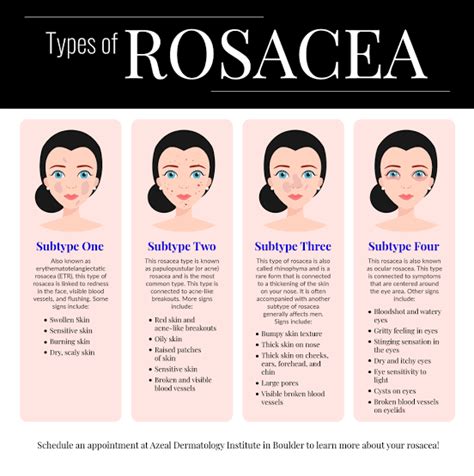 Rosacea Types Symptoms Causes And Treatment Santripty