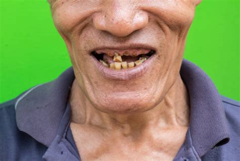 Best Ugly Teeth Stock Photos Pictures And Royalty Free Images Istock