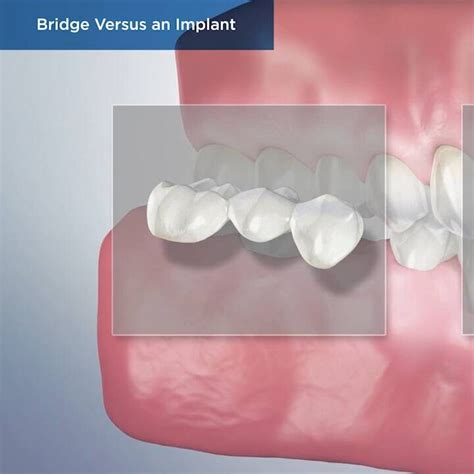 Bridge Versus an Implant – Victory Dental Clinic