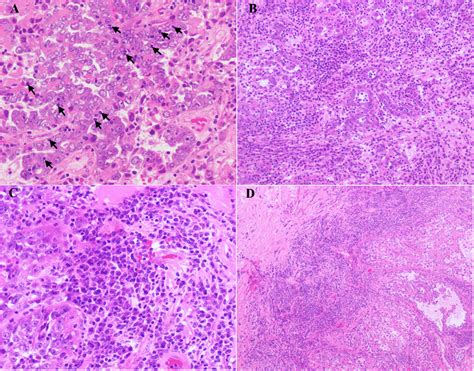 Tumor Infiltrating Lymphocytes TILs A Arrows In Tumor Cells