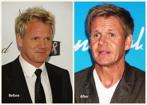 Gordon Ramsay Plastic Surgery Facelift Before and After (Star plastic ...