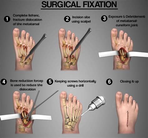 The Doctor Is In What Does A Lisfranc Sprain Mean For Najee Harris