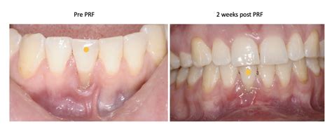 Prf Grafting In Implant Dentistry Dr Jaclyn Wong Melbourne