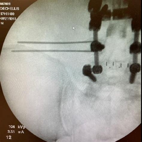 (PDF) Superior Cluneal Neuralgia Treated With Wireless Peripheral Nerve ...