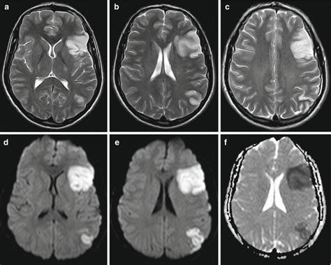 Vascular Disease Ischemic Stroke Neupsy Key