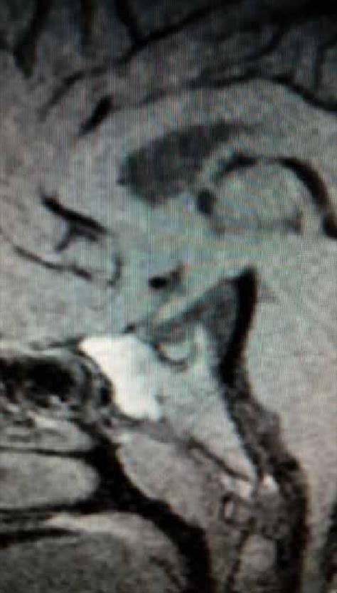 Pituitary Magnetic Resonance Image Download Scientific Diagram