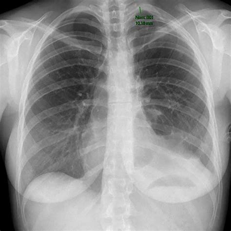 Chest Radiography Showing Small Residual Pneumothorax After Chest Tube