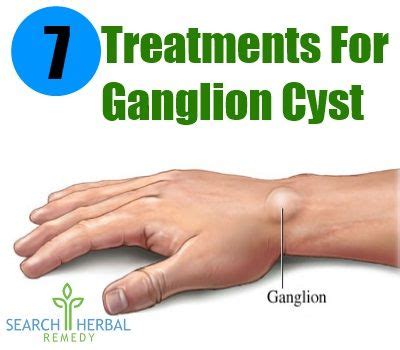 Ganglion Cyst Ankle Home Treatment : How to get rid of ganglion cysts with this home remedies ...