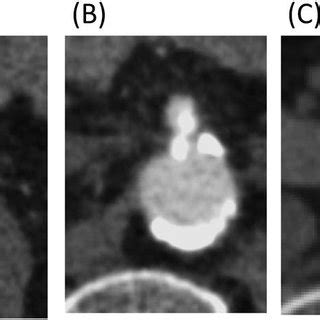 Pre Operative Findings Of Contrast Enhanced Computed Tomography Each