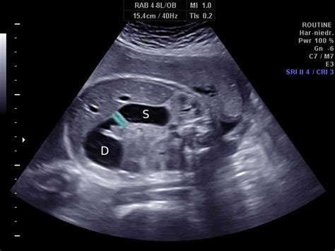 Duodenal Atresia Ultrasound