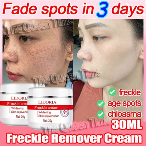 Melasma Cream Pekas Remover Effective Melasma Dark Spot Remover Brightening Whitening Freckle